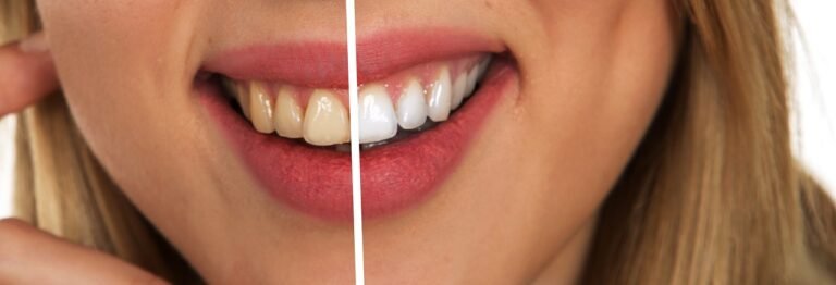¿Cómo tener dientes más blancos? 1 dientes mas blancos, con blanqueamiento dental