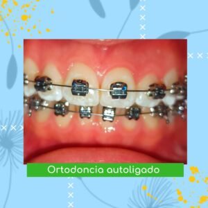 ortodoncia autoligado