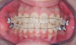 brackets en ceramica