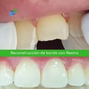 Reconstrucción de borde con resina