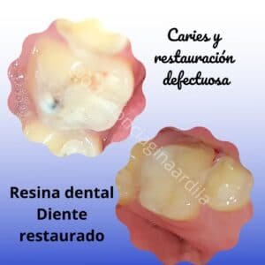 resinas dentales