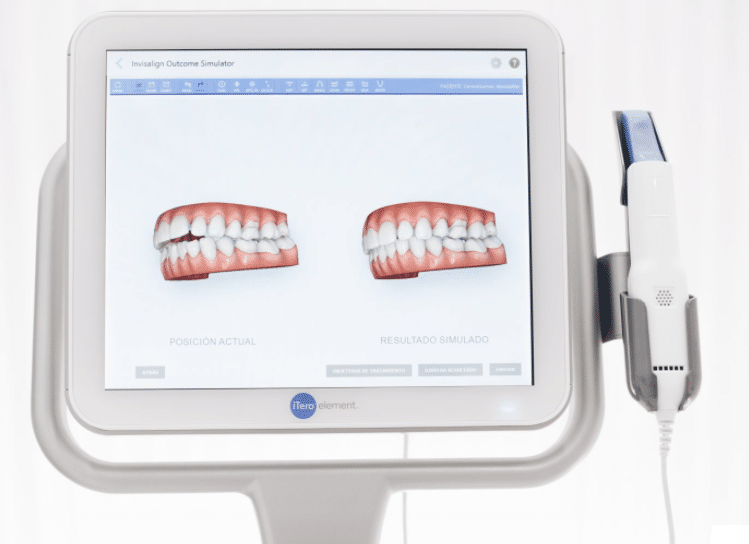 Escaner intraoral para brackets invisibles