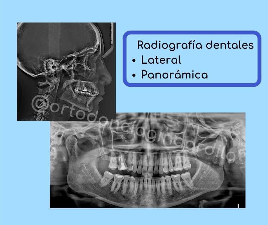 radiografías dentales