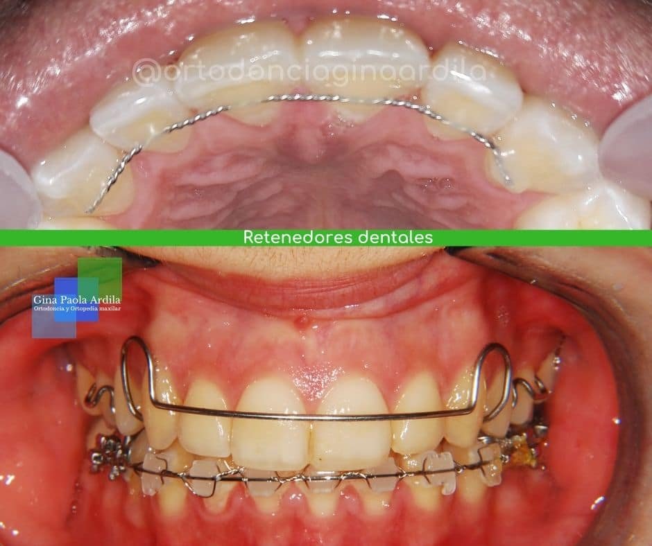 Polinizar T Mutuo 1 Razón para usar los retenedores dentales Dra. Gina Ardila