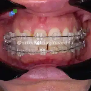 brackets zafiro